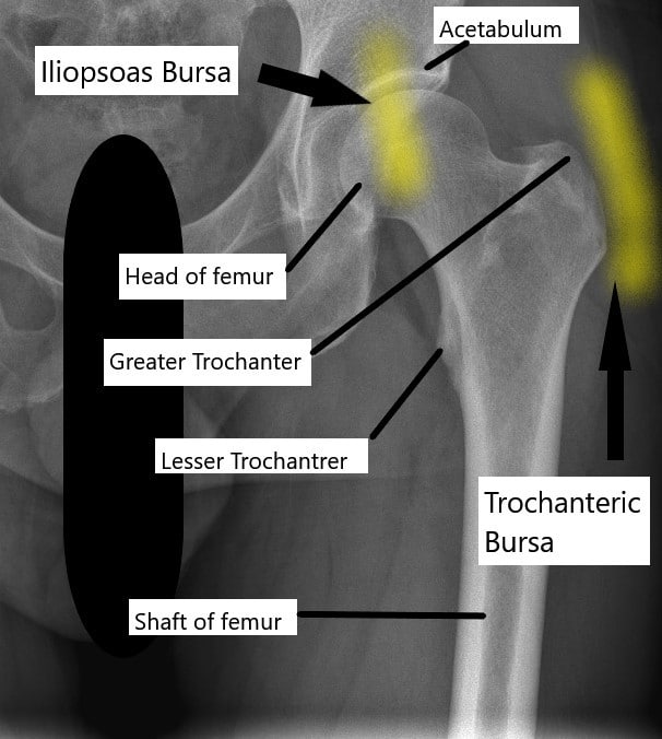 X-ray of the hip joint and its relation to the trochanteric bursa and iliopsoas bursa.
