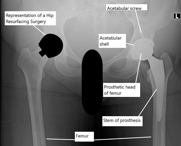 X-ray showing a total hip replacement on the left hip and an illustration of hip resurfacing on the right hip.