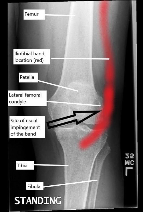 A knee x-ray illustrating the location of iliotibial band and the usual site of impingement.