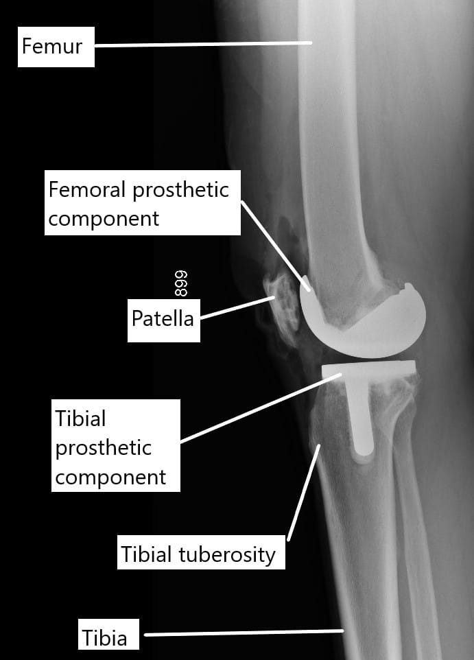 X-ray showing a total knee replacement.
