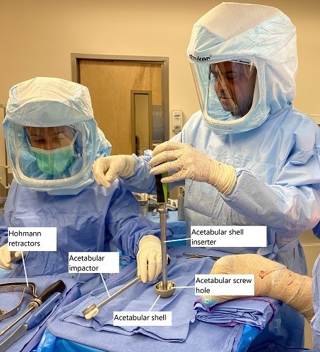 Intraoperative image showing loading of the prosthetic acetabular shell. Intraoperative image showing loading of the prosthetic acetabular shell.