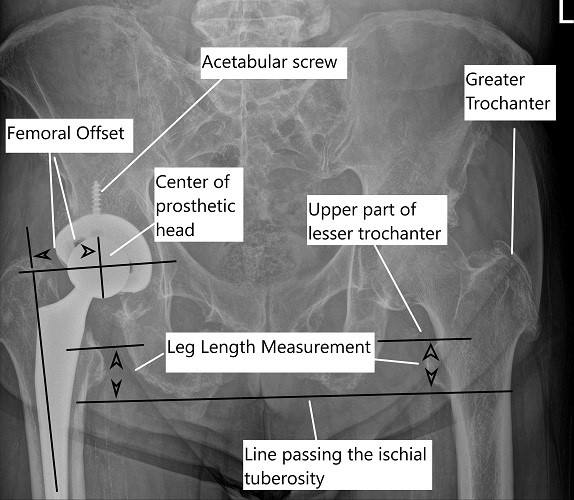 X-ray of the pelvis showing leg length measurement in a post-op total hip replacement of the right hip.