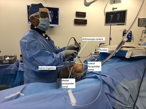 Intraoperative image showing arthroscopic repair of MPFL. Intraoperative image showing arthroscopic repair of MPFL.
