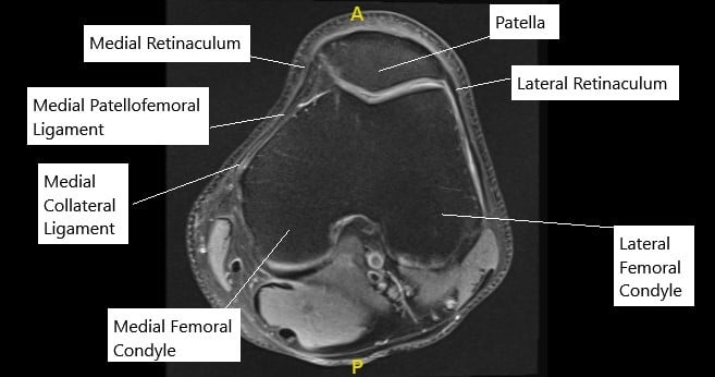 MRI of the knee in axial section showing normal MPFL.
