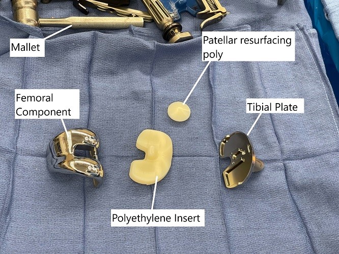 Intraoperative image showing the implants used in a total knee replacement surgery.
