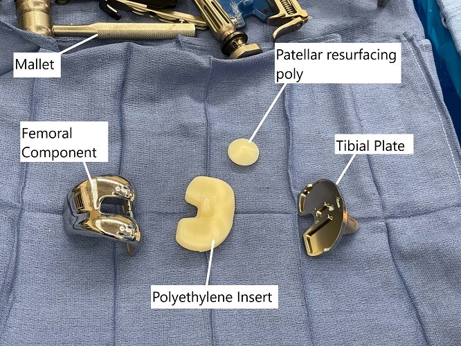 Intraoperative image showing the implants used in a total knee replacement surgery. Intraoperative image showing the implants used in a total knee replacement surgery.