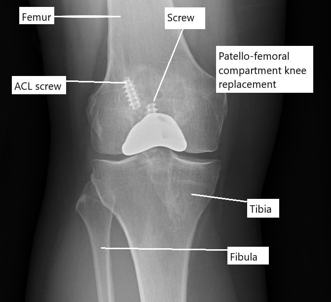 X-ray showing a partial knee replacement.