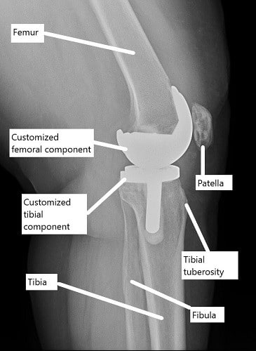 X-ray showing a custom knee replacement.