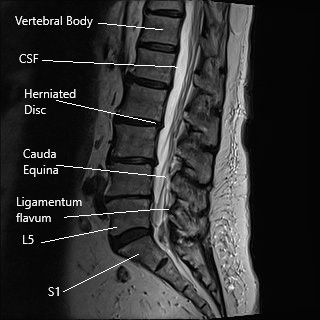 MRI of the lumbar spine in sagittal section.