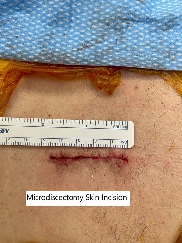 Intraoperative image showing the surgical skin incision after closure.