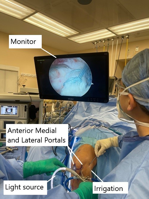 Intraoperative image showing ACL reconstruction.