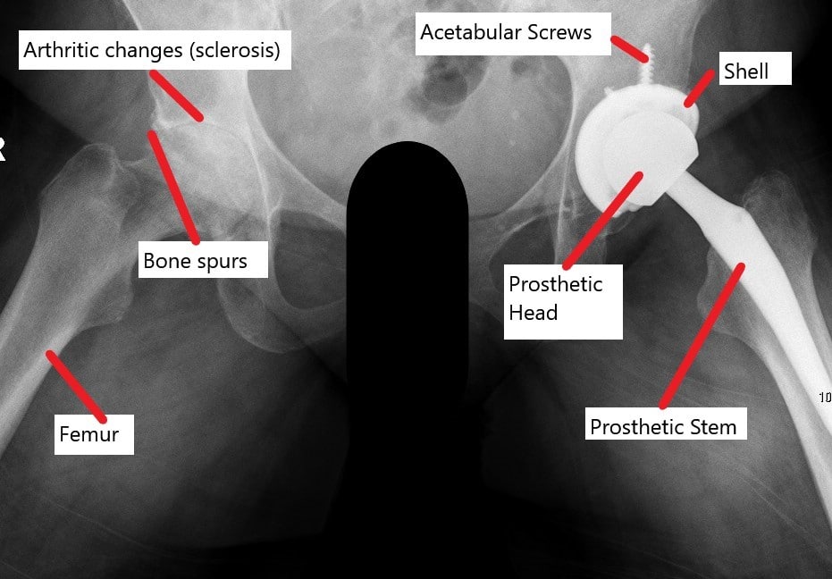 X-ray showing a total hip replacement with a contralateral arthritic joint.