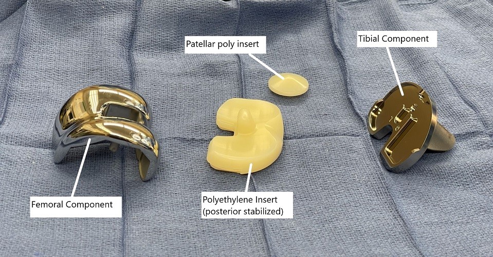 Intraoperative image showing knee replacement implants.