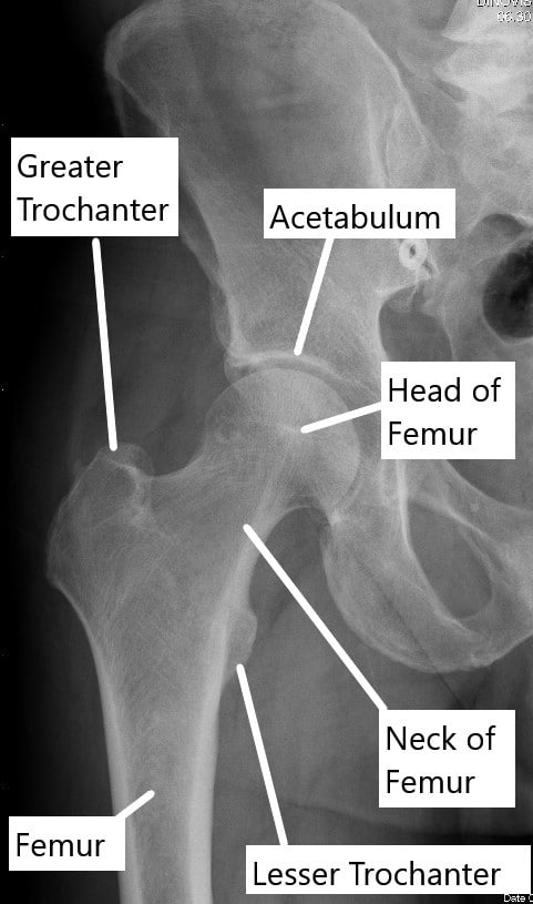 X-ray showing normal anatomy of the hip joint.