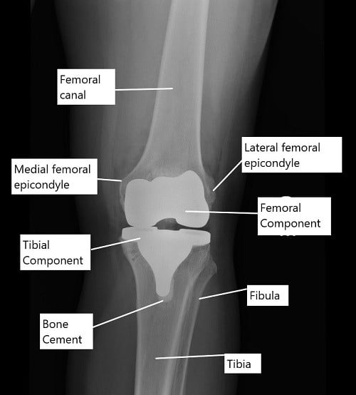 X-ray showing a total knee replacement in AP view.