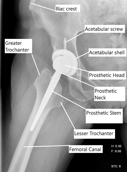 X-ray showing a lateral view of a total hip replacement.