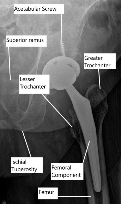 Outpatient Hip Replacement Complete Orthopedics Multiple Ny Locations