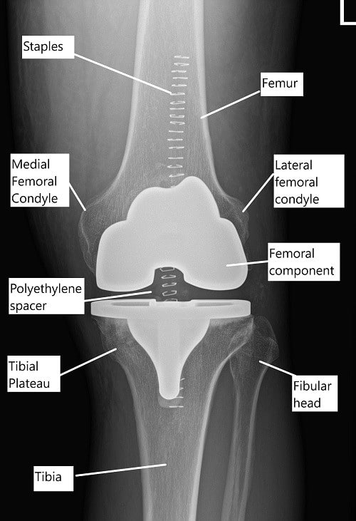 Postoperative X-ray showing a total knee replacement.