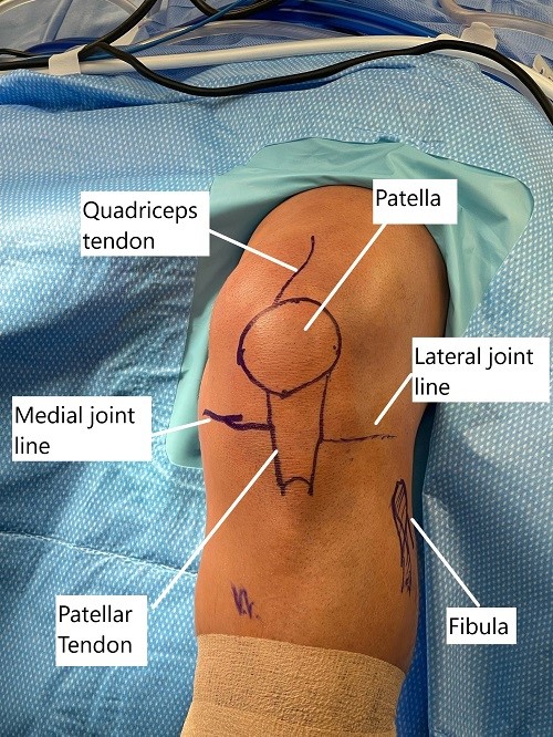 Intraoperative skin markings of the knee joint before arthroscopic reconstruction.