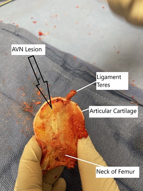 Removed head of femur during surgery showing avascular necrotic lesion.