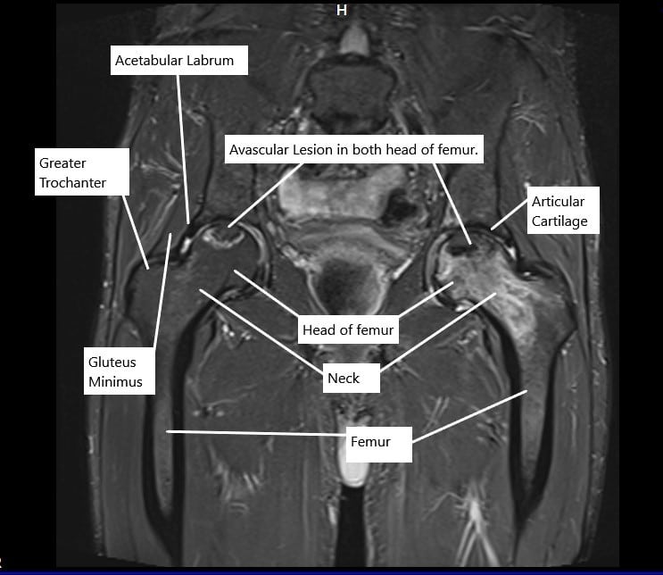 MRI in the coronal section showing avascular necrosis lesions in both hips.