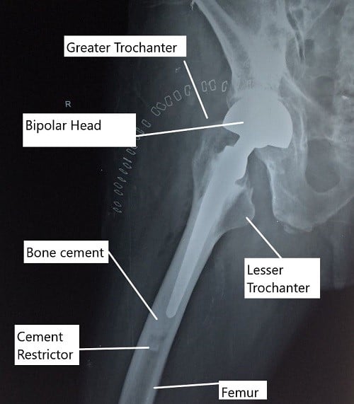 X-ray of the hip in lateral view showing a partial cemented hip replacement.