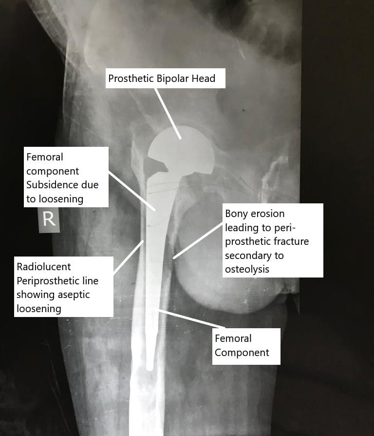 X-ray showing aseptic loosening of the hip replacement.