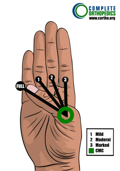 Scheduled Loss of Use for Upper Extremities - Complete Orthopedics