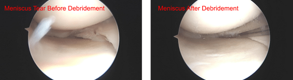 Meniscus before and after Debridement