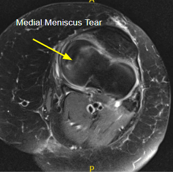 MRI of the left knee suggested radial tear of the medial meniscus and medial collateral ligament sprain/tear.