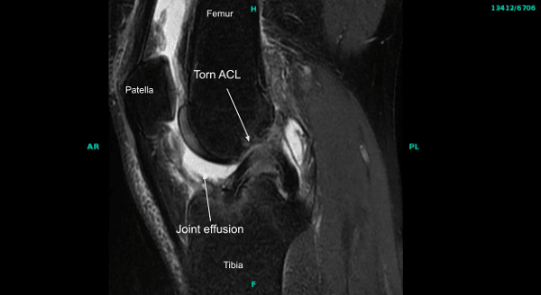 MRI of the right knee joint