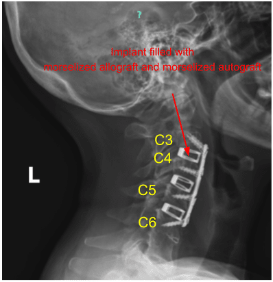 Cervical Spine Sagittal view X-ray