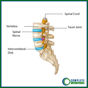 Diagram of herniated disc or prolapsed intervertebral disk