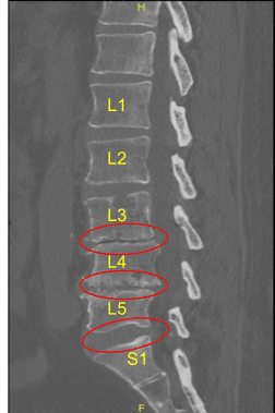 Protuberancia discal y artropatía facetaria