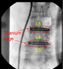 Radiografía intraoperatoria