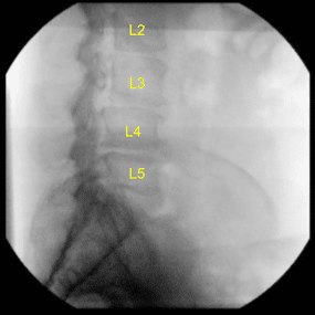 Radiografía intraoperatoria
