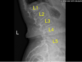 Estado de la radiografía postoperatoria de la columna lumbar Post vertebroplastia de L1 Vista sagital
