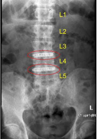 Radiografía postoperatoria