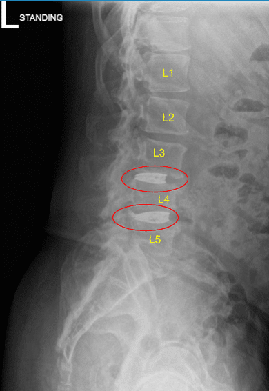 Vista Saggital de rayos X postoperatoria