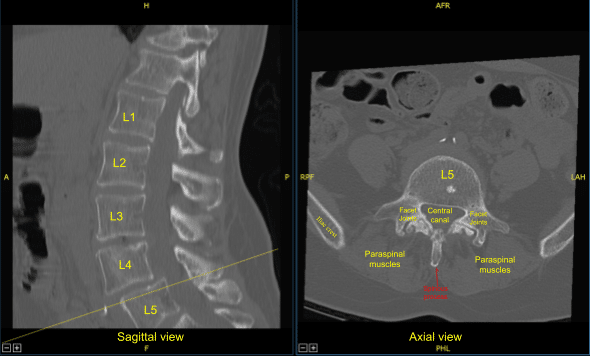 Preoperative CT of Lumbar Spine