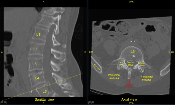 TC preoperatoria de la columna lumbar