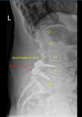 Fusión espinal de L4-L5