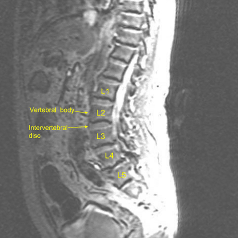 Vista sagital de la resonancia magnética preoperatoria de la columna lumbar