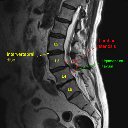 Vista sagital de la resonancia magnética preoperatoria de la columna lumbar