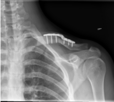Resultados de la radiografía de 12 semanas de la clavícula izquierda después de la cirugía