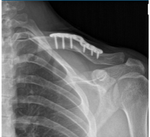 14 weeks X-ray results of left clavicle after surgery