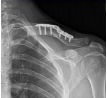 Resultados de la radiografía de 14 semanas de la clavícula izquierda después de la cirugía