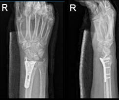 AP and Lateral View of Patient RT 2 weeks Post-operative