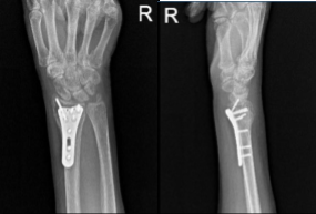 AP and Lateral View of patient RT wrist 2 weeks Post-operative