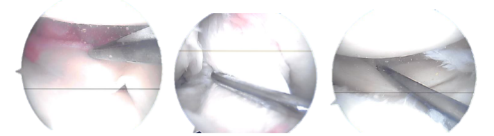 Imágenes artroscópicas reales tomadas durante la operación